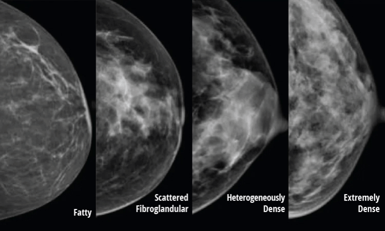 Breast Density Information