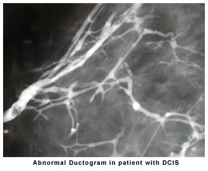 Abnormal Ductogram in patient with DCIS