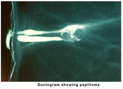 Ductogram showing Papilloma