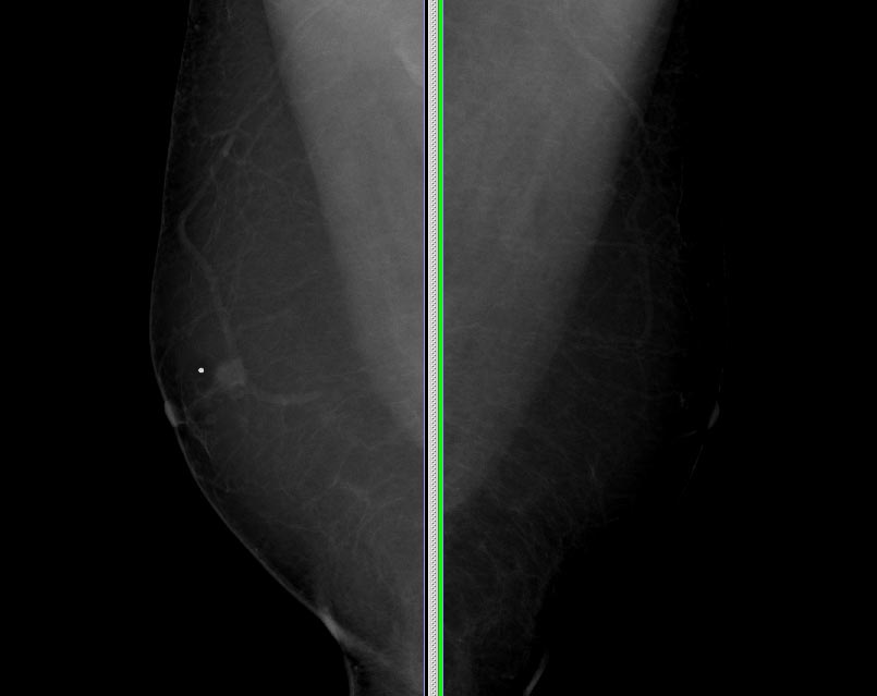 Male Breast Cancer