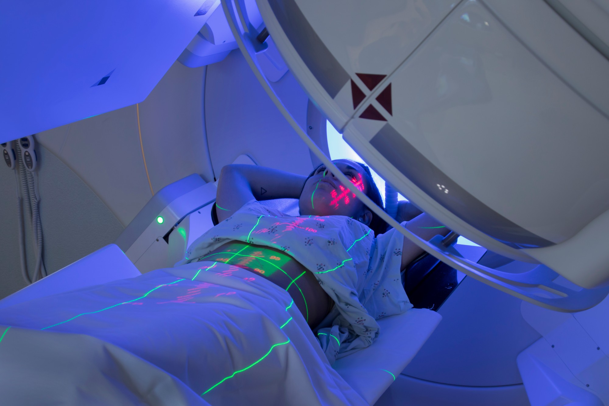 Demystifying Radiation Therapy in Early-Stage Breast Cancer