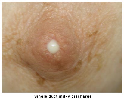 https://breastlink.com/sites/default/files/images/single-duct-milky-discharge.jpeg?utm_source=chatgpt.com