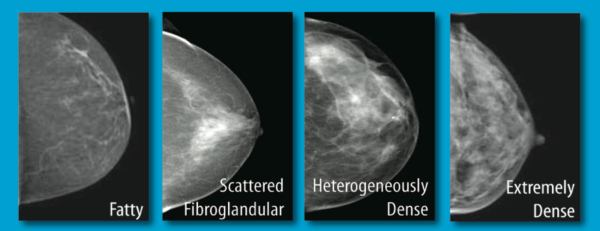 Scattered Fibroglandular Densities